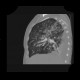 Atypical pneumonia, Pneumocystis pneumonia, PCP: CT - Computed tomography